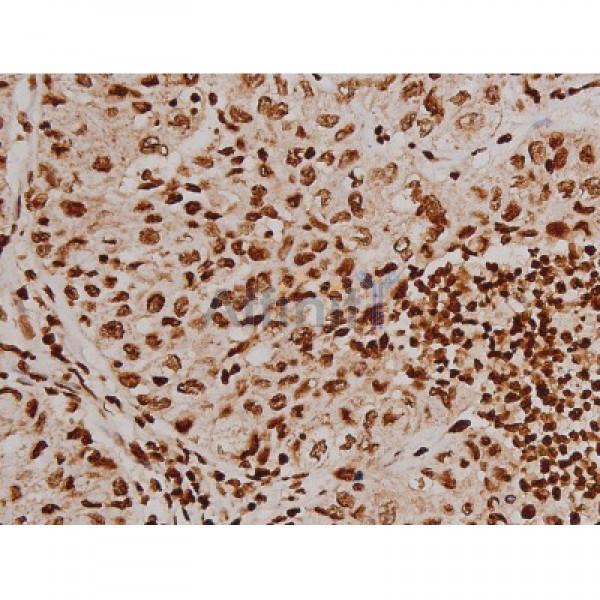Phospho-FAK (Tyr397) Antibody - AF3398 at 1/200 staining Human lung cancer tissue sections by IHC-P.
